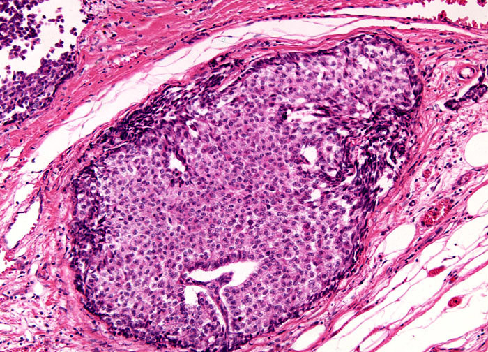 Lymph Node Metastatic Carcinoma At 10x Magnification MicroscopyU